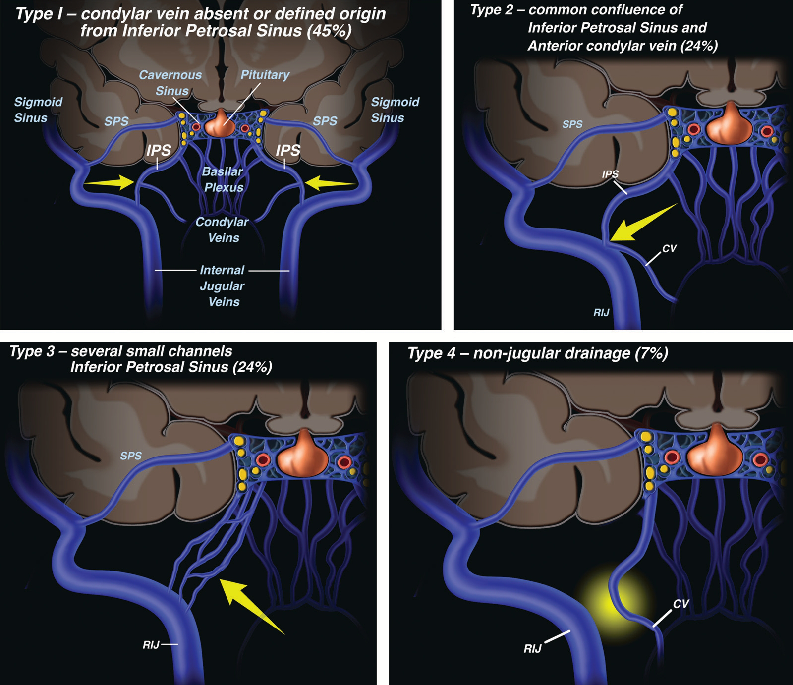 Petrosal venous anomalies
